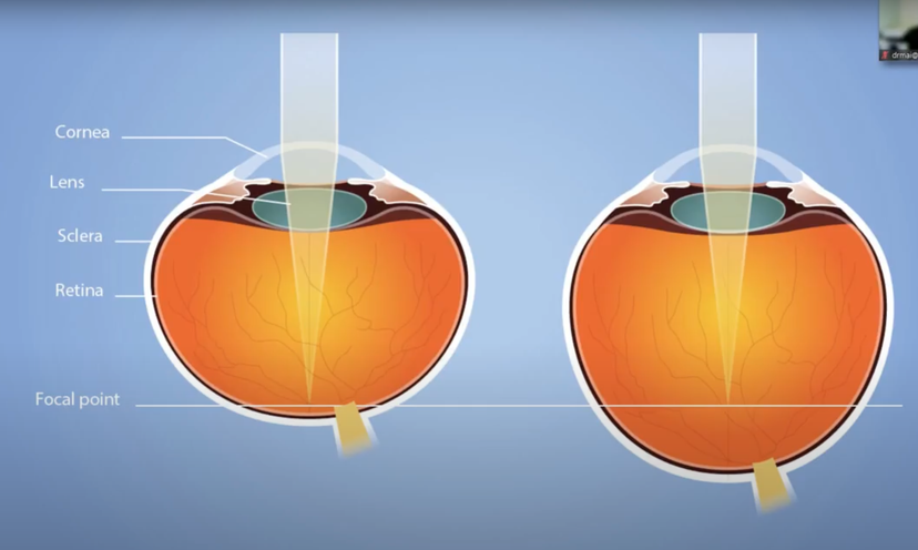 The Myopia Consultation - Dr Thanh Mai